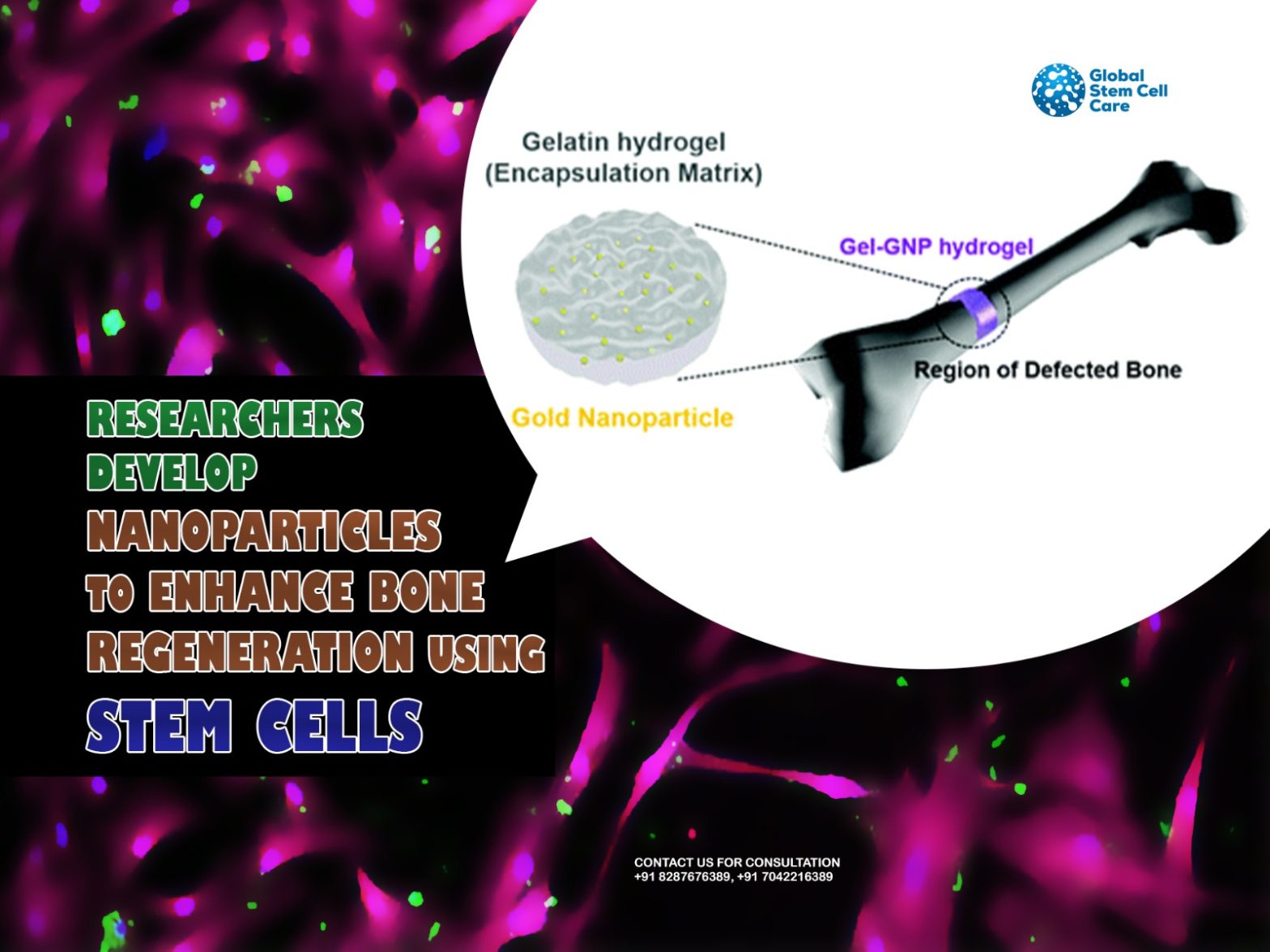 Researchers Develop Nanoparticles to Enhance Bone Regeneration Using Stem Cells
