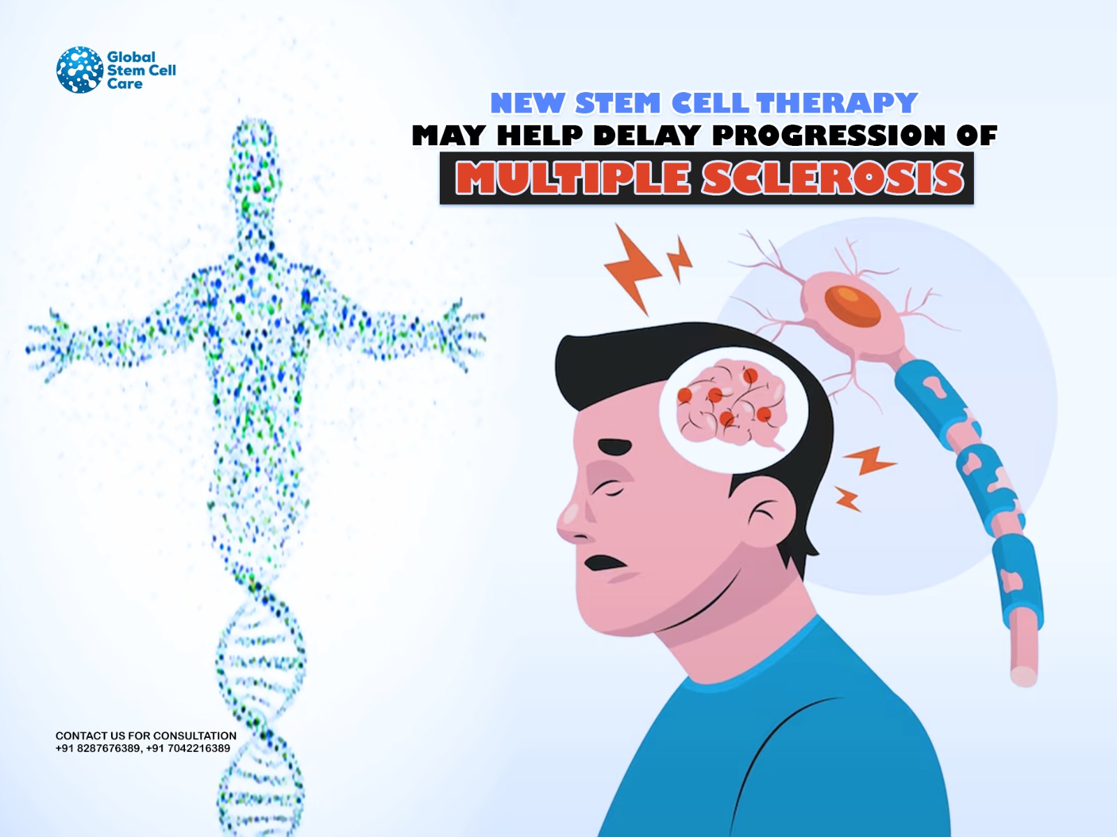New Stem Cell Therapy May Help Delay Progression of Multiple Sclerosis New Stem Cell Therapy May Help Delay Progression of Multiple Sclerosis