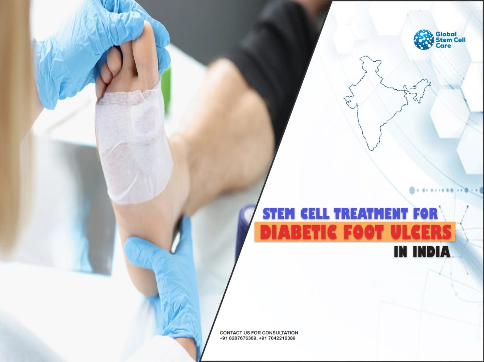 Why Is Stem Cell Treatment Important for Diabetic Foot Ulcers?
